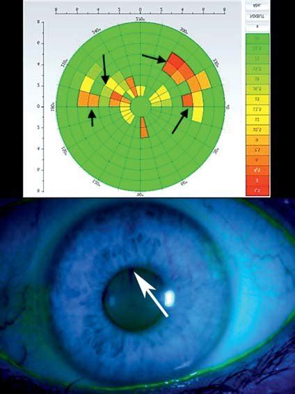 tear testing|tear film break up test.